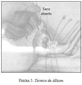 Técnica de Allison, Saco abierto
