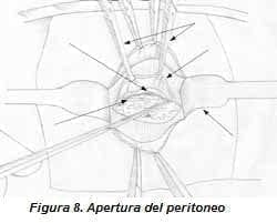 Apertura del Peritoneo