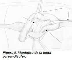 Maniobra de la Boga Perpendicular