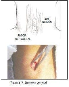 Incisión en Piel Incisión en Piel
