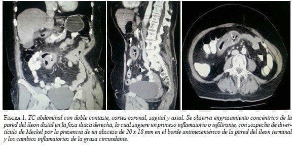 TC Abdominal con doble Contaste, cortes coronal, sagital y axial TC Abdominal con doble Contaste, cortes coronal, sagital y axial