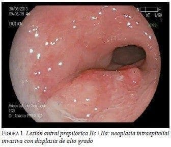 Lesion antral prepilórica IIc+IIa Lesion antral prepilórica IIc+IIa
