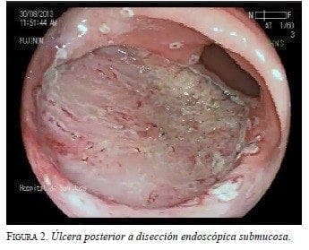 Úlcera posterior a Disección Endoscópica Submucosa Úlcera posterior a Disección Endoscópica Submucosa