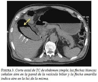 Corte axial de TC de abdomen simple Corte axial de TC de abdomen simple