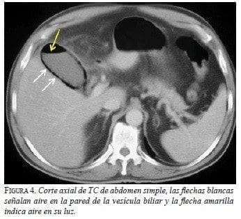Corte axial de TC de abdomen simple Corte axial de TC de abdomen simple