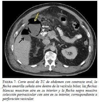 Corte axial de TC de Abdomen con Contraste Oral Corte axial de TC de Abdomen con Contraste Oral