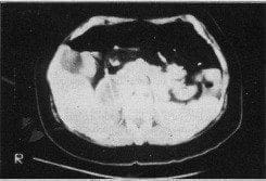 TAC abdominal TAC abdominal