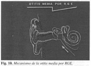 Mecanismo otitis media