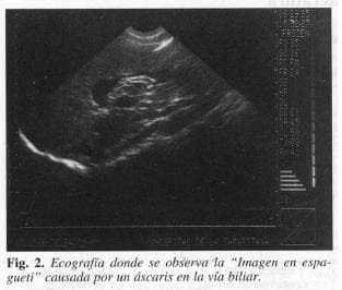 Ascaris de via biliar