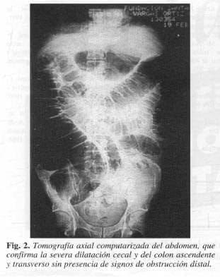 Dilatación cecal y del colon
