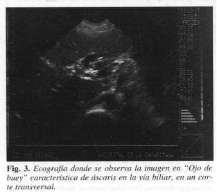 Ascaris de via biliar