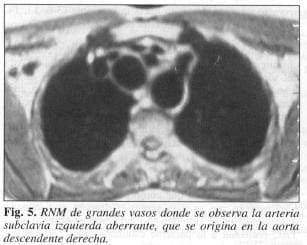 Arteria subclavia