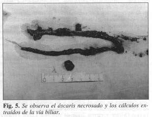 Ascaris necrosado
