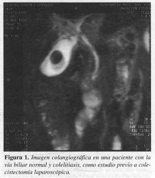 Imagen Colangiográfica en una paciente con la vía Biliar Normal y Colelitiasis