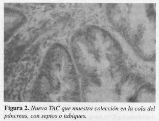 Colección en la Cola del Páncreas