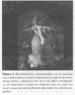Llenamiento Distal, y Dilatación Leve de la Vía Biliar Extrahepática