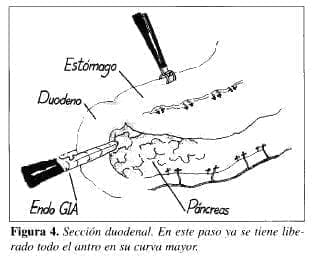 Sección Duodenal