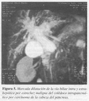 Vía Biliar Intra y Extrahepática