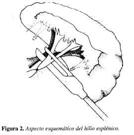 Aspecto esquemático del Hilio Esplénico Aspecto esquemático del Hilio Esplénico