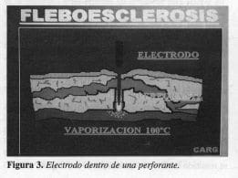 Electrodo dentro de una perforante Electrodo dentro de una perforante