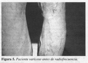 Paciente Varicoso antes de Radiofrecuencia Electrodo dentro de una Perforante