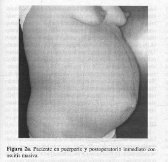 Paciente en puerperio y postoperatorio inmediato con ascitis masiva