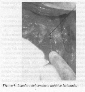 Ligadura del conducto Linfático Lesionado