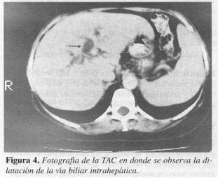 Dilatación de la Vía Biliar Intrahepática