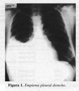 Empiema Pleural Derecho Empiema Pleural Derecho