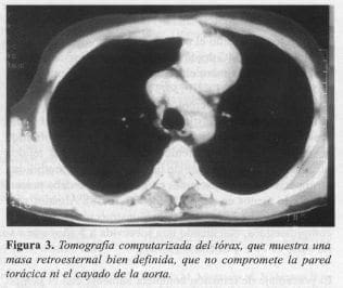 Masa Retroesternal bien Definida Masa Retroesternal bien Definida