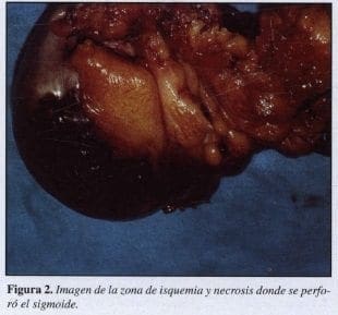 Zona de Isquemia y Necrosis donde se perforó el Sigmoideo