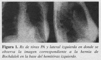 Hernia de Bochdalek