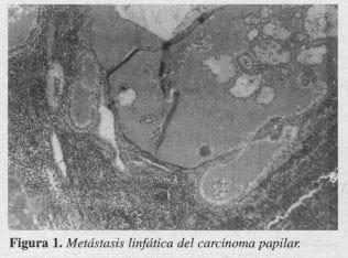 Metástasis Linfática del Carcinoma Papilar Metástasis Linfática del Carcinoma Papilar