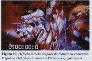 Defecto Directo después de reducir su Contenido