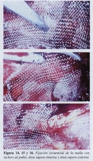 Herniorrafia Inguinal, Fijación secuencial de la malla