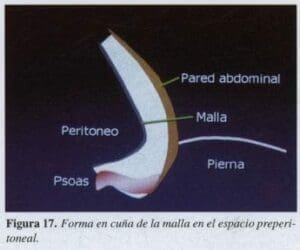 Herniorrafia Inguinal, Forma en cuña de la malla