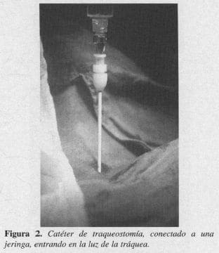 Catéter de Traqueostomía Catéter de Traqueostomía