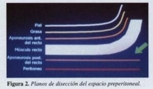 Herniorrafia Inguinal, Planos de disección