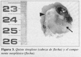 Quiste Tirogloso Quiste Tirogloso