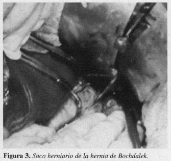 Saco Herniario de la Hernia de Bochdalek