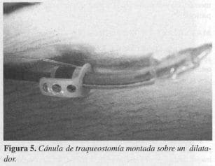 Cánula de Traqueostomía Cánula de Traqueostomía
