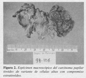 Espécimen Macroscópico del Carcinoma Papilar Tiroides