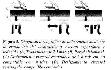 Diagnóstico Ecográfico de Adherencias