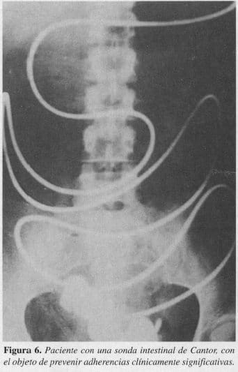 Paciente con una Sonda Intestinal de Cantor