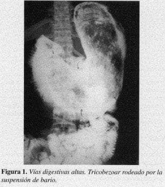 Vías Digestivas Altas