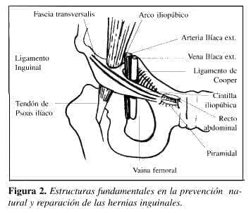 Herniorrafia Preperitoneal: structuras fundamentales en la prevención natural Herniorrafia Preperitoneal: structuras fundamentales en la prevención natural