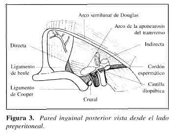 Herniorrafia Preperitoneal: Pared inguinal Herniorrafia Preperitoneal: Pared inguinal