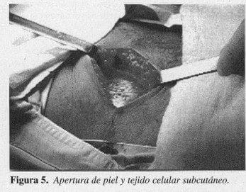 Apertura de piel y tejido celular subcutáneo
