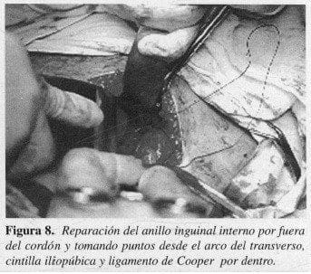 Reparación del anillo inguinal interno por fuera del cordón