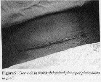 Cierre de la pared abdominal plano por plano hasta la piel